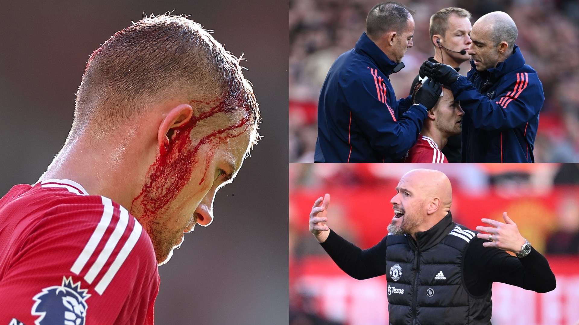 Ten Hag furious as Brentford score with De Ligt's head cut open  