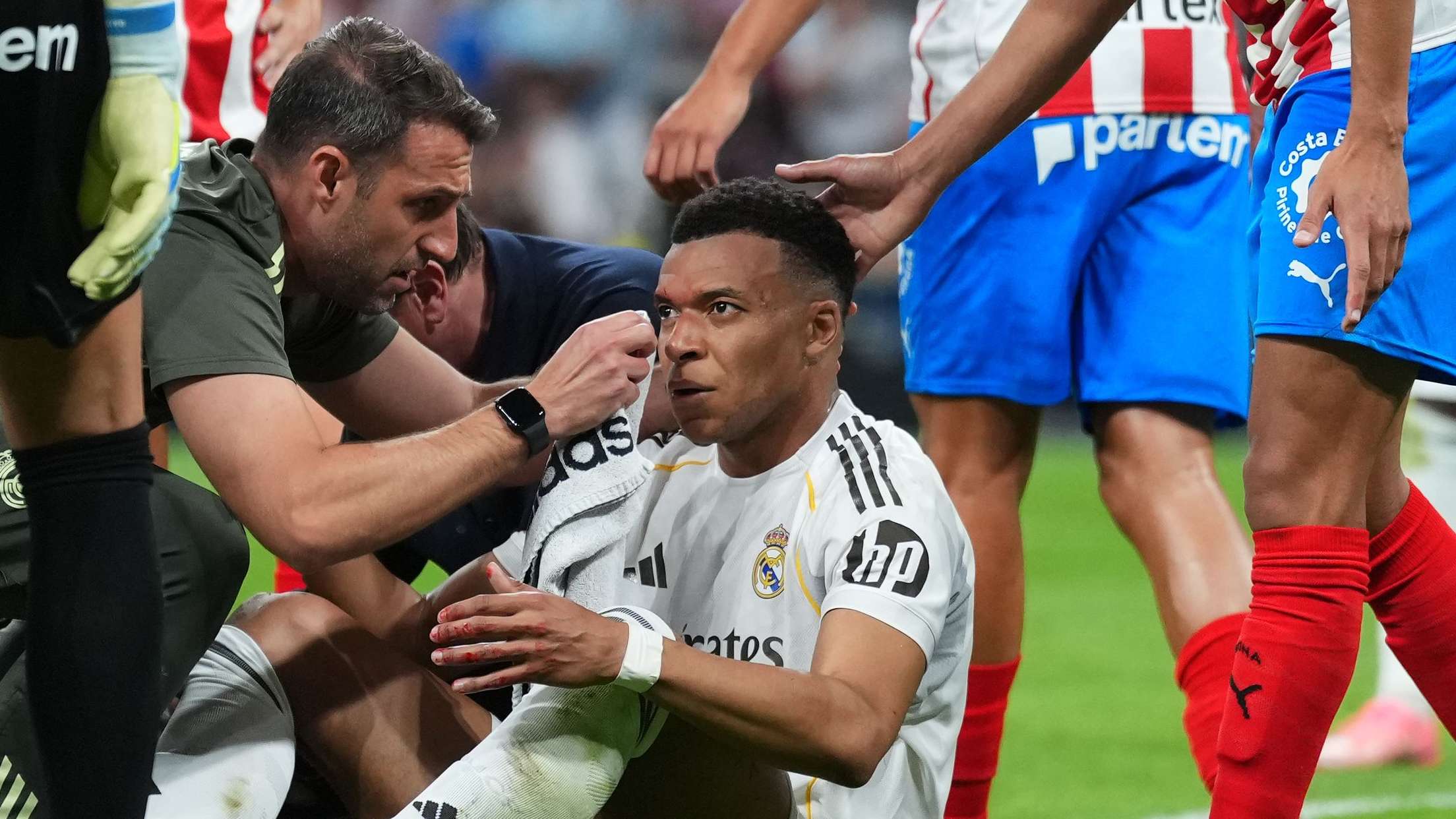 Mbappe shows off gruesome face injury  